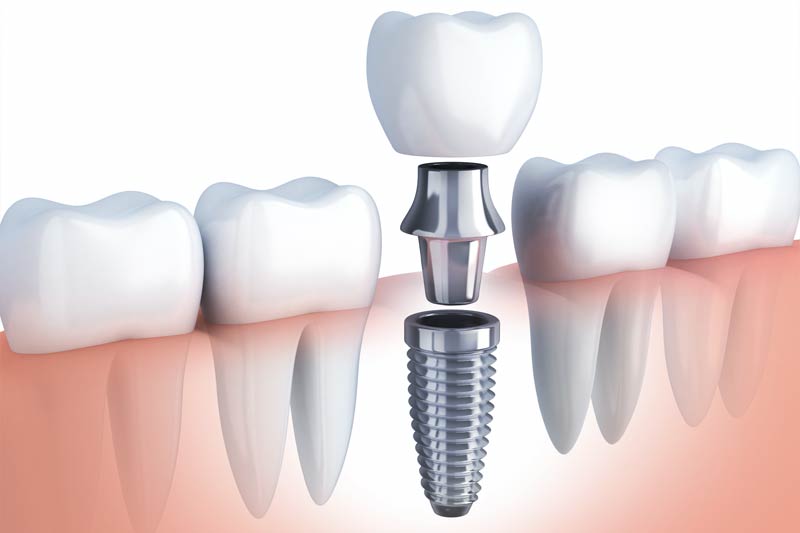 Implants Dentist in Leesburg