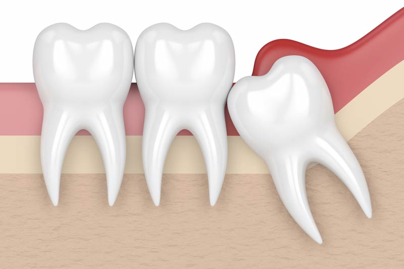 Wisdom Tooth Removal in Leesburg
